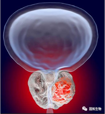 前列腺癌新药！基肽酶抑制剂talabostat联合Keytruda在腺癌表型晚期难治性mCRPC疗效令人鼓舞!